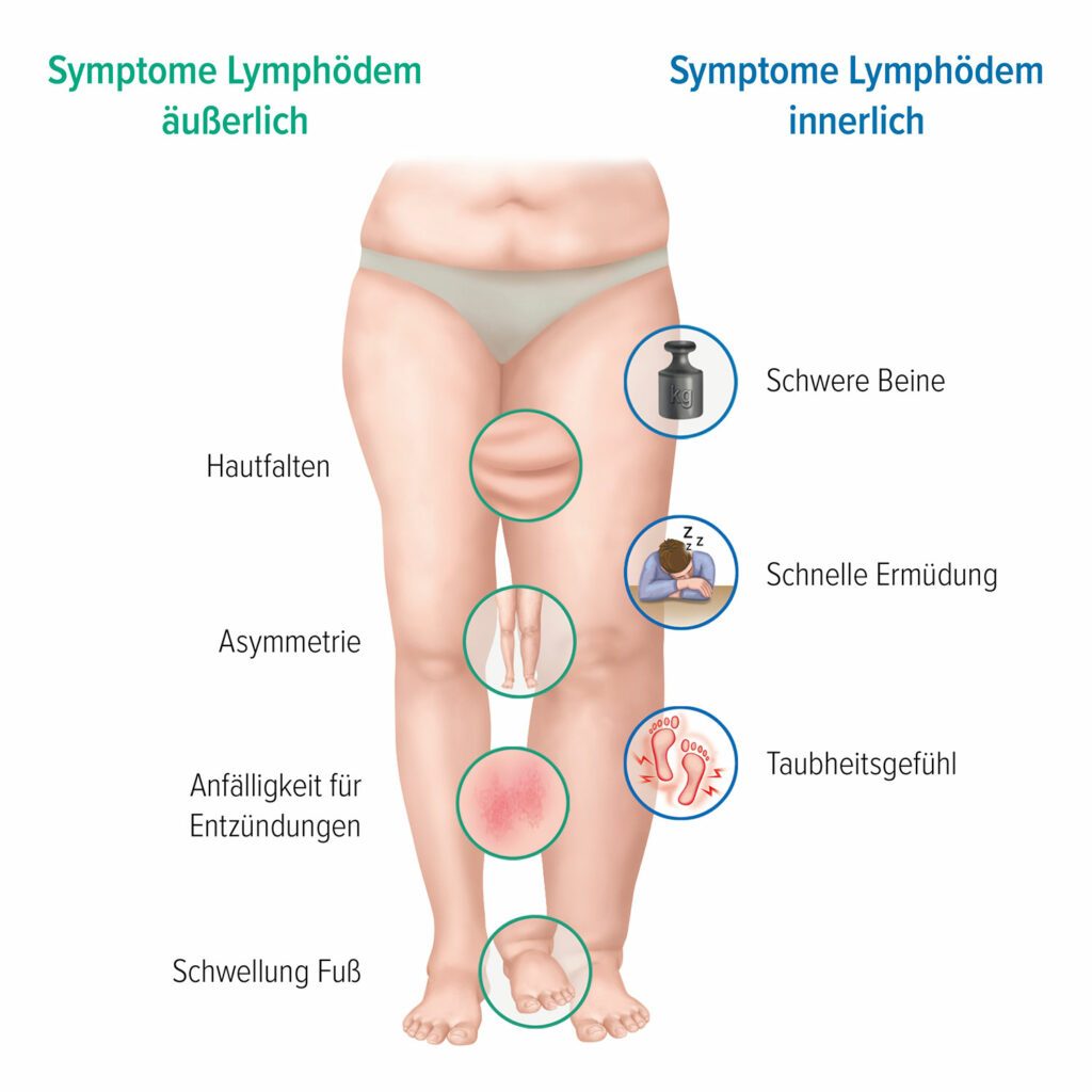 Grafische Darstellung der Symptome eines Lymphödems
